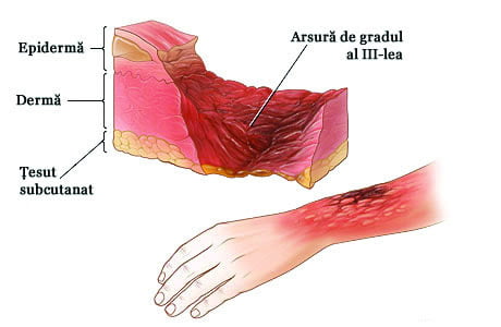 primul ajutor in caz de arsura de gradul III